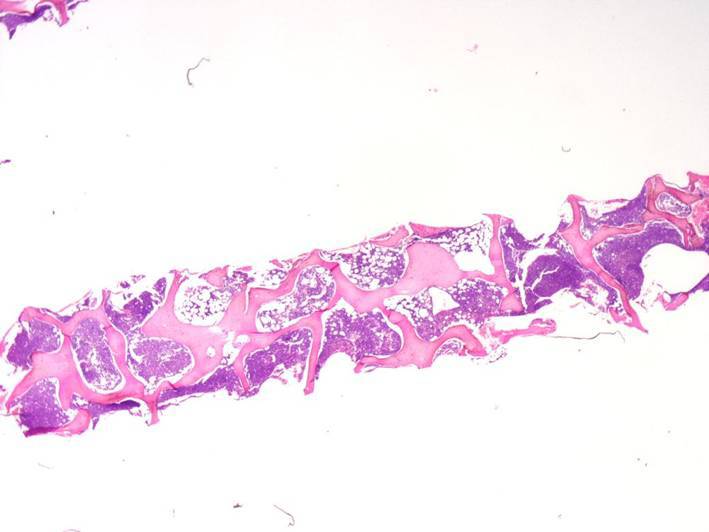third bone marrow biopsy